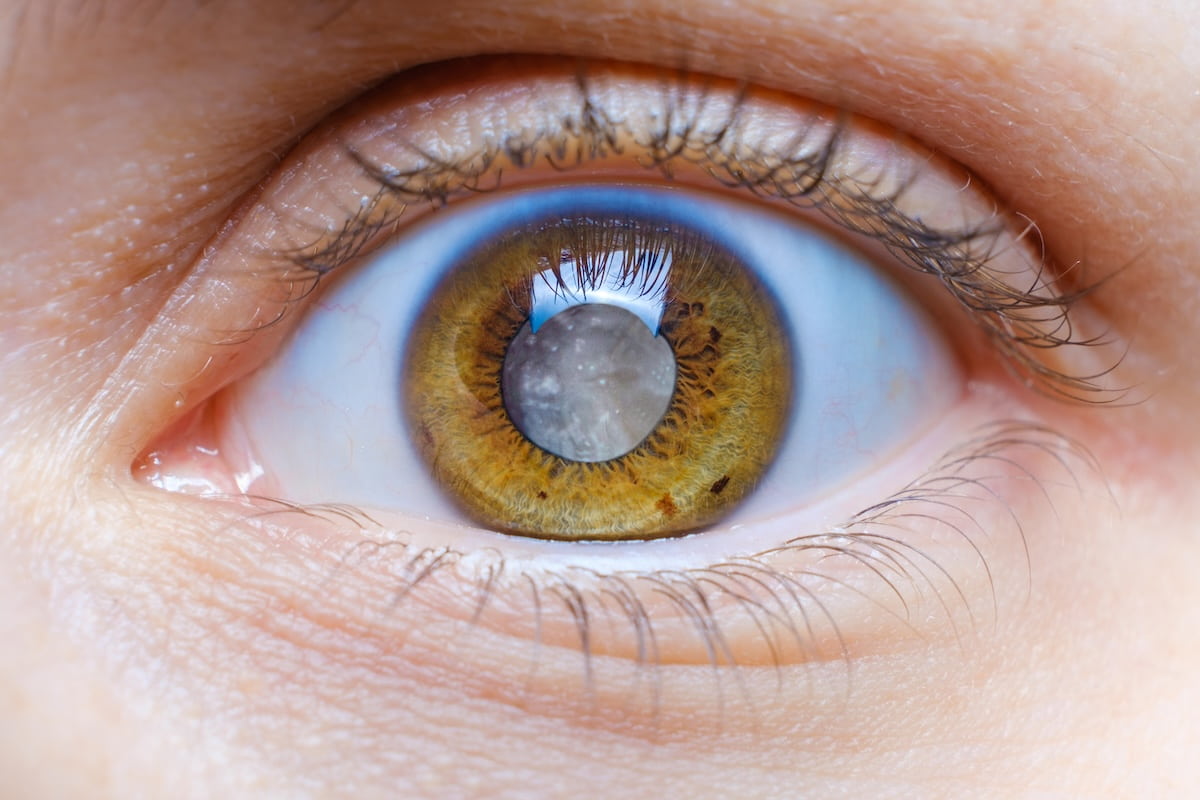 El ojo de una mujer joven con una catarata en los ojos como ejemplo de que las cataratas pueden ser hereditarias.