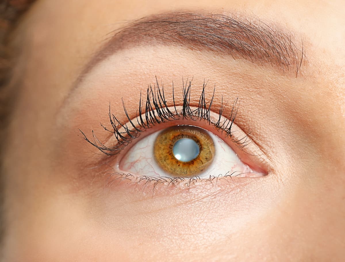 Ojo humano con opacidad blanquecina en el cristalino, ilustrando las principales causas de las cataratas en los ojos.